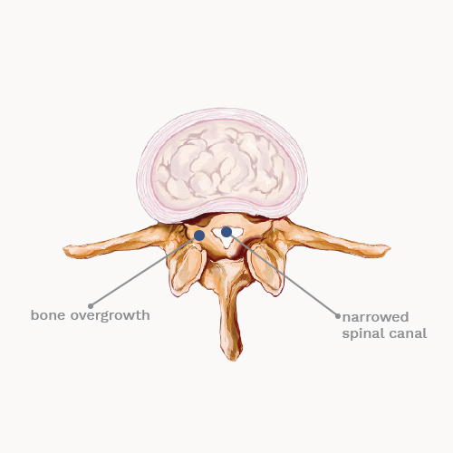  ←Spine with stenosis